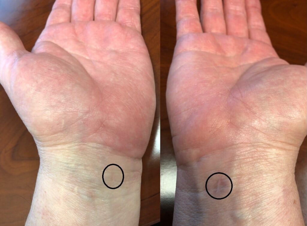 Close-up of Andy Duncans palm and wrist showing MicroKnife scars and skin details.