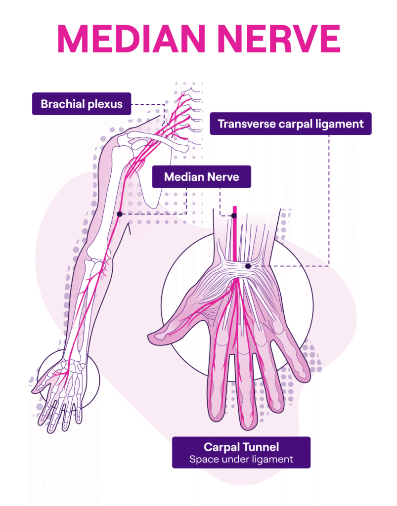 Anatomical diagram of the median nerve, brachial plexus, and carpal tunnel in the hand.