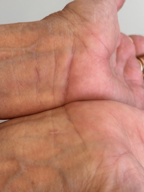 Close-up of two wrists showcasing no scar after having CTR-US.