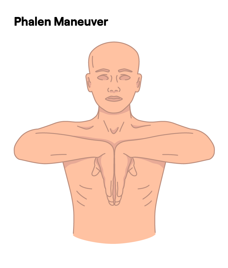 Phalen Maneuver demonstration for diagnosing carpal tunnel syndrome.