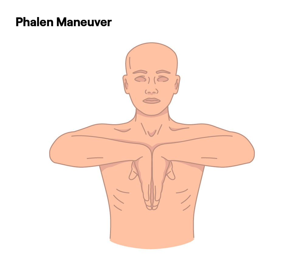 Anatomical illustration of the Phalen Maneuver to assess carpal tunnel syndrome.